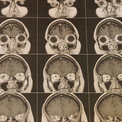 the brain, the causes