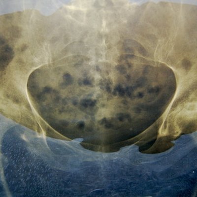 An X-ray, hip pain, walking
