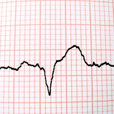 Heart palpitations, pregnancy