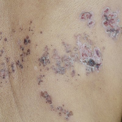 Herpes zoster