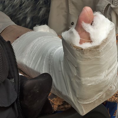 Broken Foot