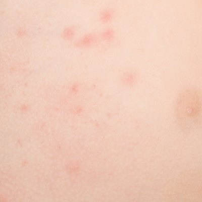 rash