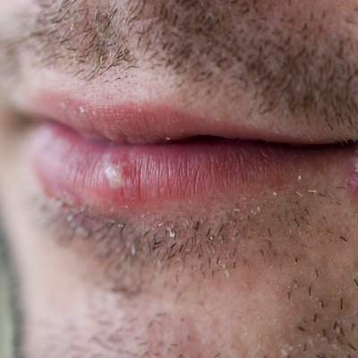 Cold sores (herpes labialis)