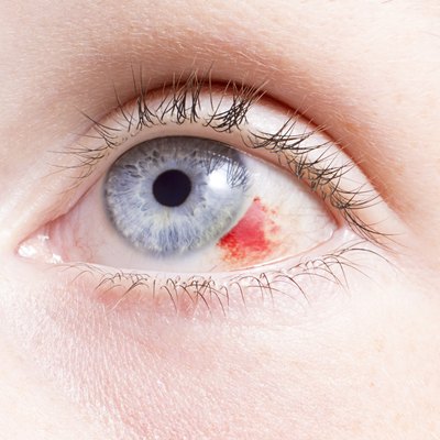 eye injury