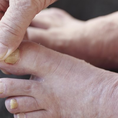 Athletes foot dry skin on man
