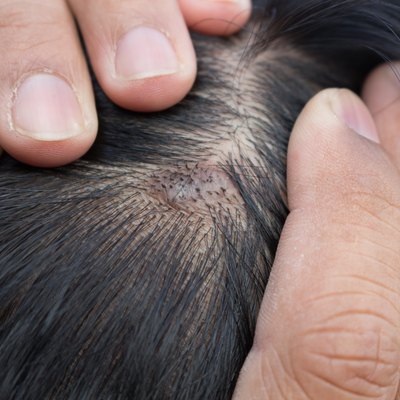 skin disease on the head