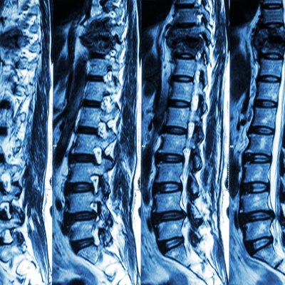 fracture of thoracic spine and compress spinal cord