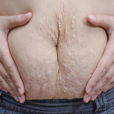 Asian woman showing her stretch marks