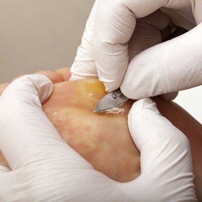 Remove skin on a wart with the scalpel