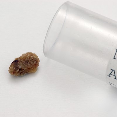 Kidney Stone