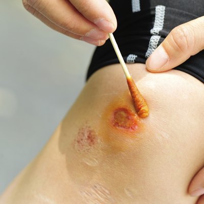 cleaing sports injured knee with medical cotton bud