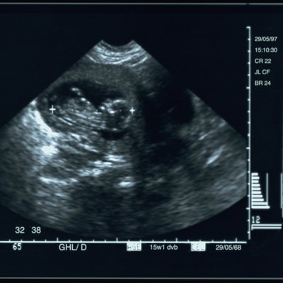 ultrasound image of a human fetus