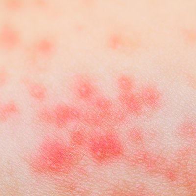 ill allergic rash dermatitis eczema skin texture