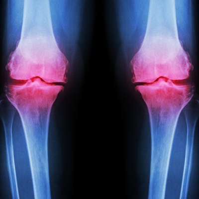 Osteoarthritis Knee ( OA Knee )