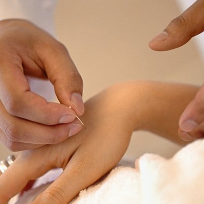Acupuncture
