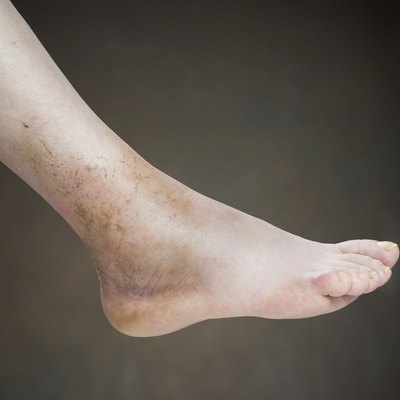 ankle sprain