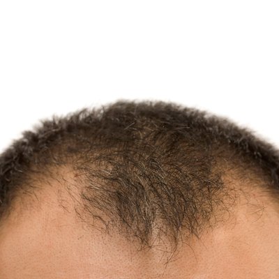 getting bald