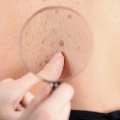 Dermatologist examines birthmark of patient, close up