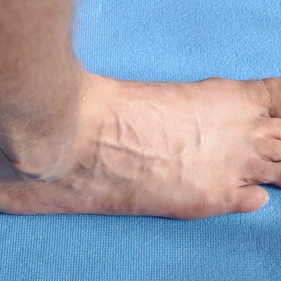 Toenail fungus with varicose veins