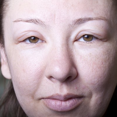 girl with allergenic edema