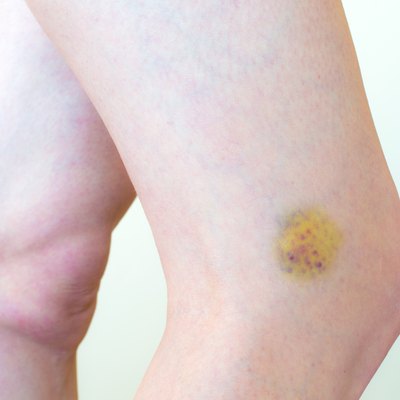 Bruised skin, a leg with pain