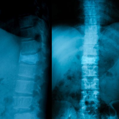 X-ray image of vertebral column.