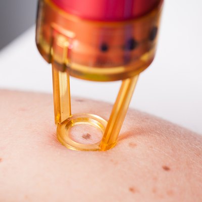 Removing mole by medical laser