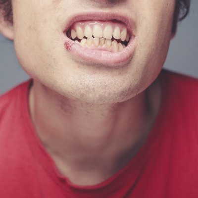 Young man with cold sore and plaque on his teeth
