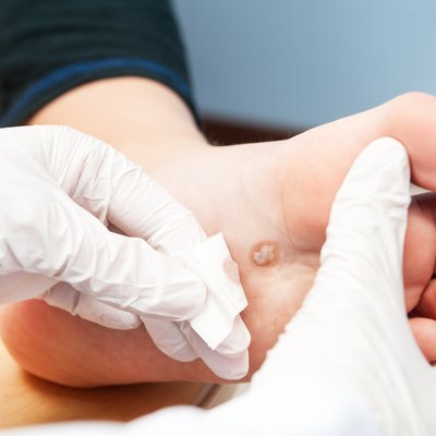 wart
