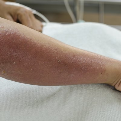 Arm of patient allergic to herbicide