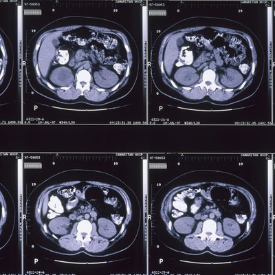 MRI