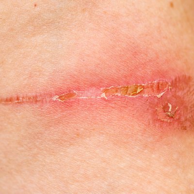 Burn Scar Detail