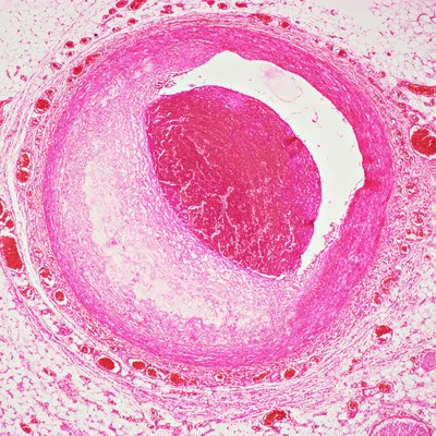 Coronary artery