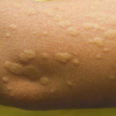 Urticaria