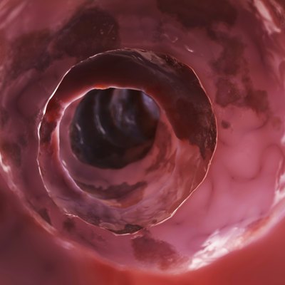 unhealthy colon