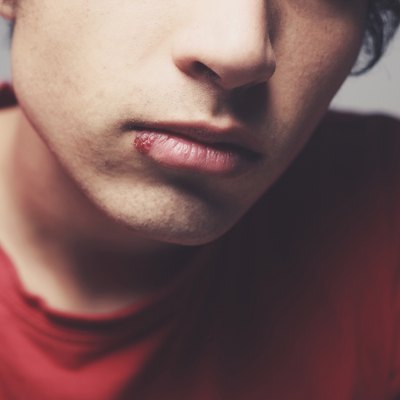 Man with cold sore