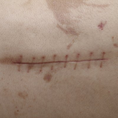 Back Surgery Scar