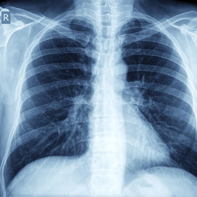 X-ray of chest