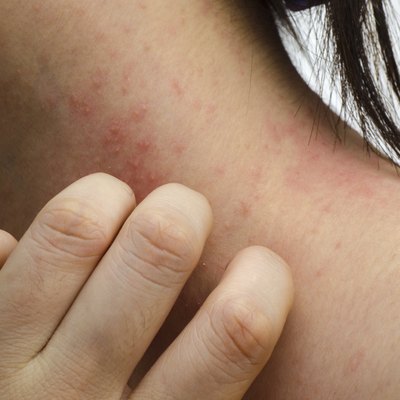 eczema skin on neck