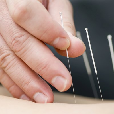 Treatment by acupuncture