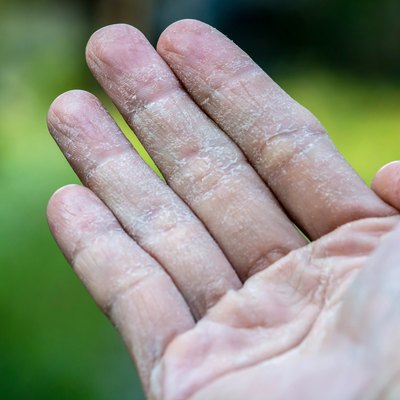 Male Hand with Ecxema
