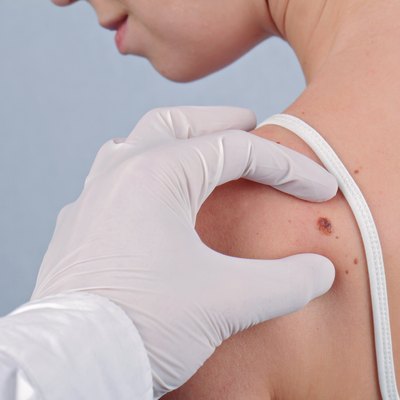 Doctor dermatologist examines birthmark of patient close up