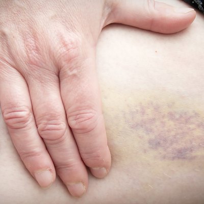 Holding Bruise on Leg
