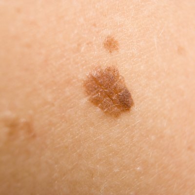 Mole on person's skin