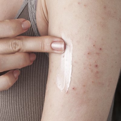 allergic rash dermatitis skin texture of patient
