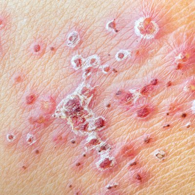 Herpes Zoster (Shingles) - after treatment
