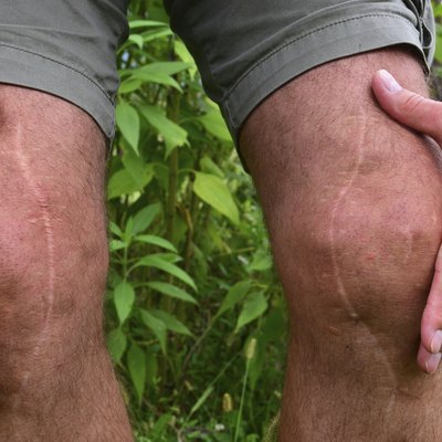 Scars