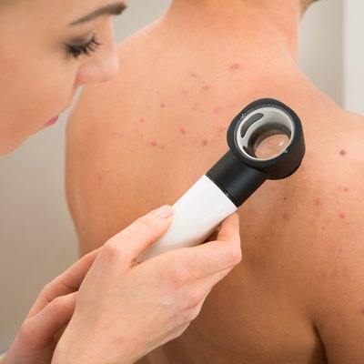 Doctor Examining Pigmented Skin