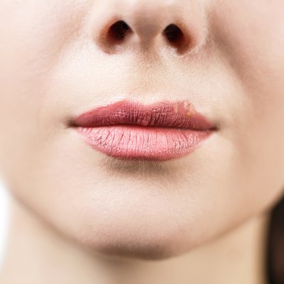 Beautiful lips infected herpes virus