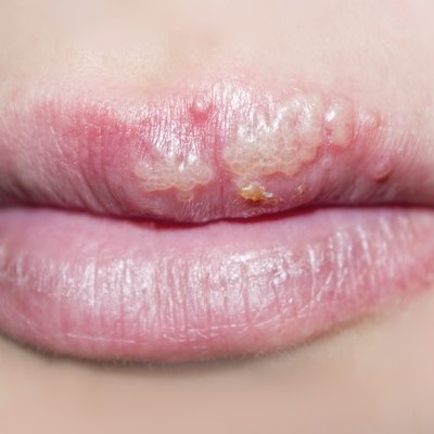 manifestation of herpes